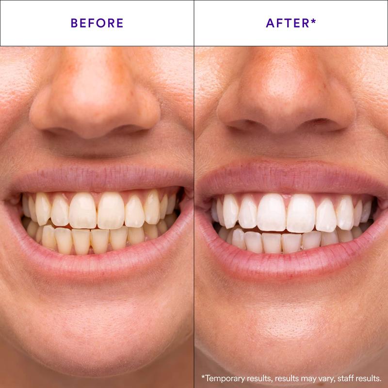 V34 Purple Whitening Strips for Instantly Whiter Teeth